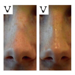 Non-Surgical Nose Job vs. Rhinoplasty: Which Is Better for Small Bump Smoothing?